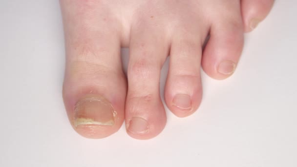 Fermer Détail Pied Humain Épaississement Des Ongles Psoriasiques Séparant Lit — Video