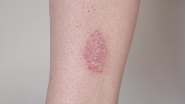 Close Flaky Skin Unrecognizable Psoriasis Patient Slowly Peeling Leg Painful — Stock Video