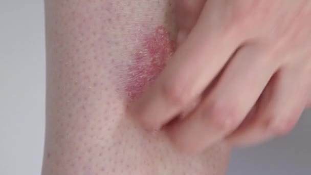 Chiudi Macchie Cutanee Squamose Rosse Infiammate Dolorose Irriconoscibili Psoriasi Paziente — Video Stock