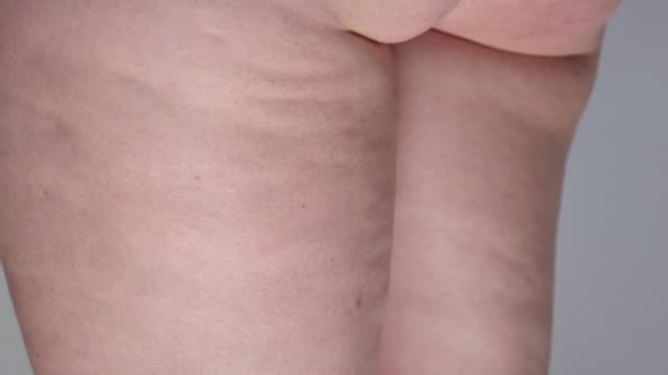 Медленное Движение Закрыть Нездоровую Жировую Ткань Быстро Нарастает Ногах Женщины — стоковое видео