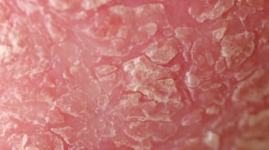 Close Up, Makro: Sedef hastalığı denilen otoimmün hastalıktan etkilenen bir dirsek üzerinde kırmızı iltihaplı deri kapsayan kuru gümüş pulların detayı. Ciddi belirtileri ile cilt alerjisi. Dermatit döküntü ve çirkin egzama