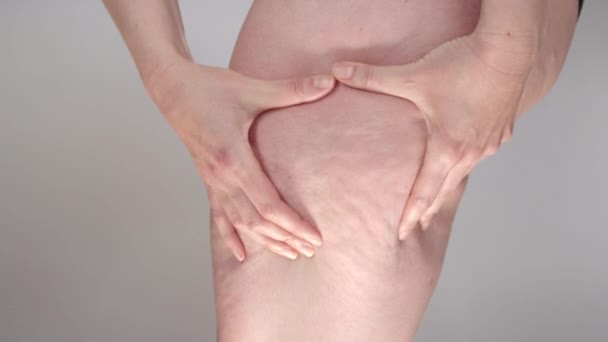 スローモーション マクロ クローズアップ 手は大腿の側面をつまみ セルライトを露出させます 不健康な食習慣と遅い代謝の結果として女性の足に蓄積する危険な脂肪組織 — ストック動画