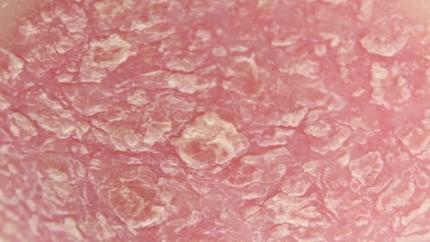 干银鳞片的细节 覆盖受自身免疫性疾病称为牛皮病的肘部红烧皮肤 皮肤过敏 症状严重 皮炎皮疹和丑陋的湿疹 — 图库视频影像