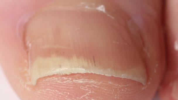 Close Macro Unrecognizable Person Applying Antifungal Corticosteroid Solution Defected Toe — Stock Video