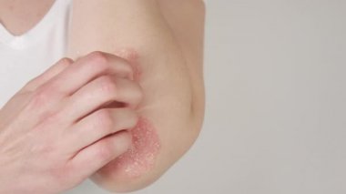 Close Up: Otoimmün tedavi edilemez dermatolojik deri hastalığı sedef denilen muzdarip tanınmayan genç kadın. Kadın hafifçe kırmızı çizilme, iltihaplı, dirsek üzerinde pullu döküntü. Psoriatik artrit