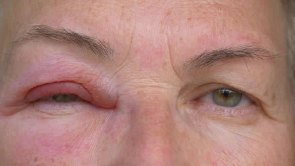 CLOSE UP: Kaukasierin mit infiziertem und geschwollenem Auge blickt in die Kamera. — Stockvideo