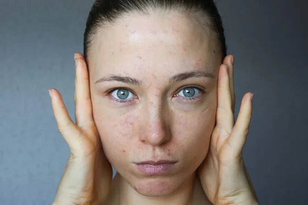 Jeune Femme Avec Problème Peau Acné Les Rides Peau Rouge — Photo