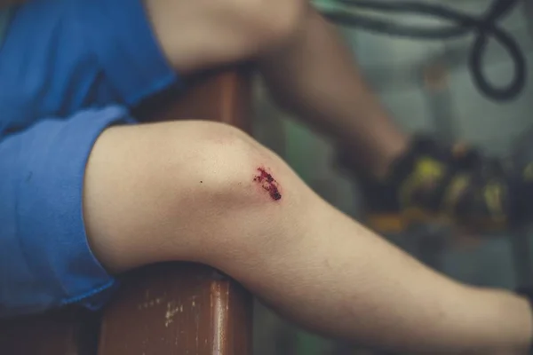 Selective Closeup Shot Child Knee Wound Blurry Background — Stock Photo, Image