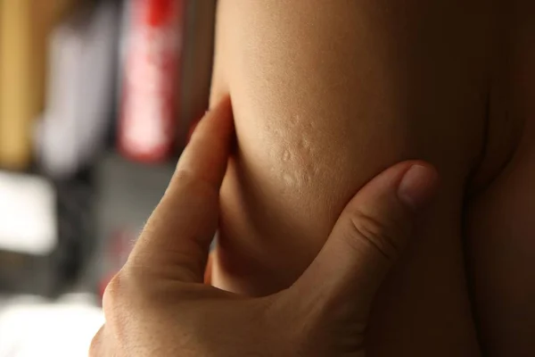 Bacille Calmette Guerin Vaccine Bcg Skin Scars — Stock Photo, Image
