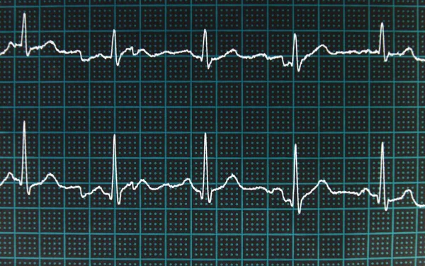 Ein Weißes Kardiogramm Auf Blauem Und Schwarzem Quadratischen Hintergrund — Stockfoto