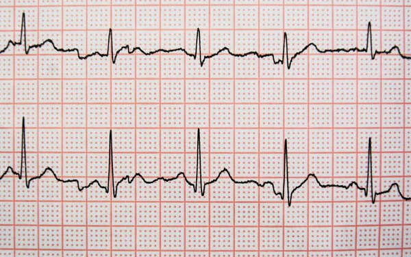 Zbliżenie Wykresu Liniowego Rejestrującego Bicie Serca Osoby — Zdjęcie stockowe