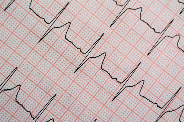 Zbliżenie Ujęcia Elektrokardiogramu Serca — Zdjęcie stockowe