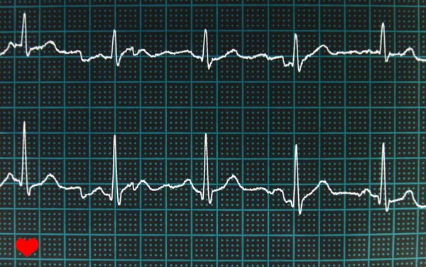 Elektrokardiogram Ekg Pulsem Serca — Zdjęcie stockowe