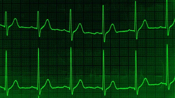 Ein Grünes Kardiogramm Auf Einem Grün Schwarzen Quadratischen Hintergrund — Stockfoto