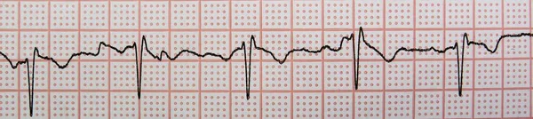심전도 막히는 — 스톡 사진