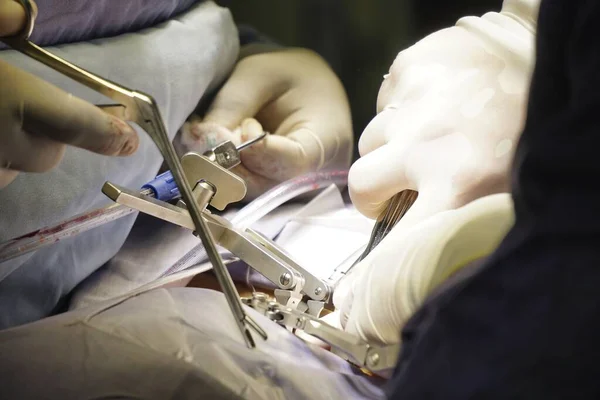 Los Angeles Estados Unidos Mar 2020 Dispositivos Cirurgia Coluna Vertebral — Fotografia de Stock