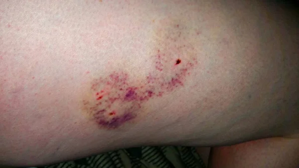 Dog Bite Wound on Caucasian Leg / Bloody Punctures and Purple Bruising
