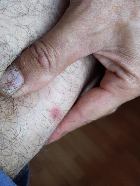 Vertical Shot Man Hand Holding Hairy Leg Acne — Stock Photo, Image