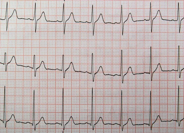 Zbliżenie Elektrokardiogramu — Zdjęcie stockowe