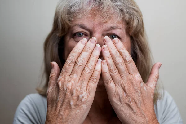 A Caucasian woman covering her face with her hands with vitiligo spots