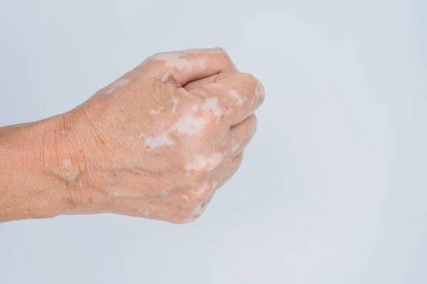 Närbild Skott Händerna Äldre Kvinna Med Vitiligo Sjukdom Grå Bakgrund — Stockfoto