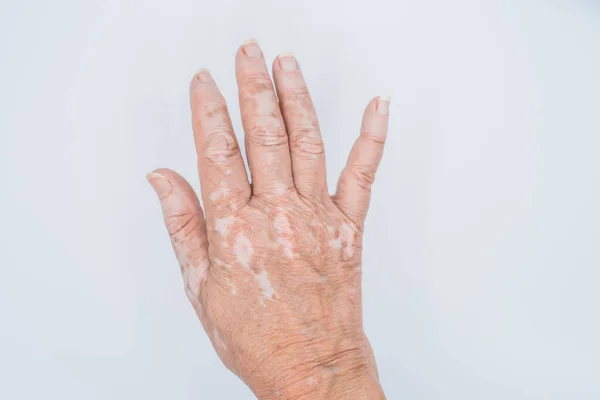 Närbild Skott Händerna Äldre Kvinna Med Vitiligo Sjukdom Grå Bakgrund — Stockfoto