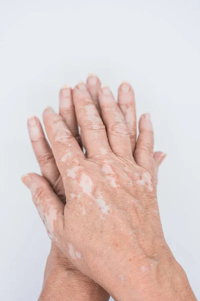 Tiro Vertical Mãos Uma Mulher Idosa Com Doença Vitiligo Fundo — Fotografia de Stock