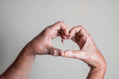 Senior Caucasian hands with vitiligo skin disorder forming a heart clipart