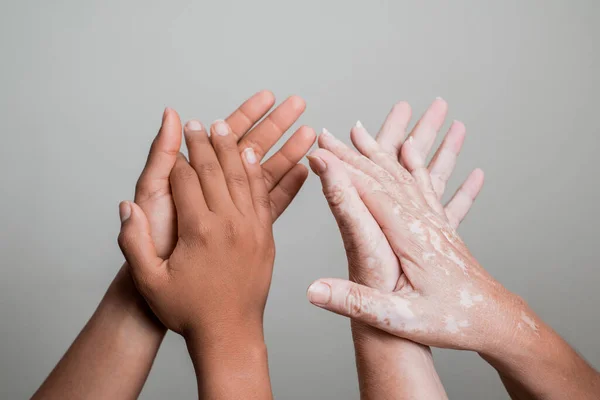 A black hand and senior hand with vitiligo clapping