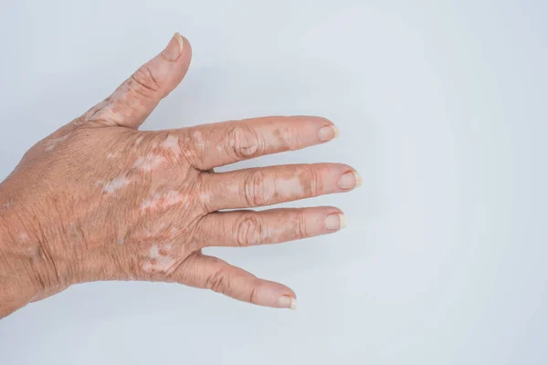 Närbild Skott Händerna Äldre Kvinna Med Vitiligo Sjukdom Grå Bakgrund — Stockfoto