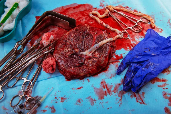 Bevalling Placenta Close Vroedkunde — Stockfoto