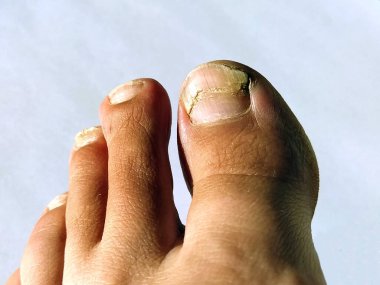 A toenail fungus at the peak of the infection. Painful toe contagious with onychomycosis. Active phase of the disease. untreated onychomycosis of the feet. clipart