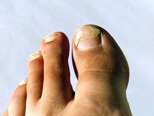 A toenail fungus at the peak of the infection. Painful toe contagious with onychomycosis. Active phase of the disease. untreated onychomycosis of the feet.