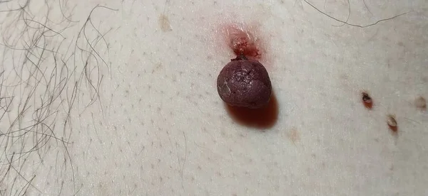 Papilomas Piel Uno Rojo Que Desaparece Varias Neoplasias Pequeñas Terapia — Foto de Stock