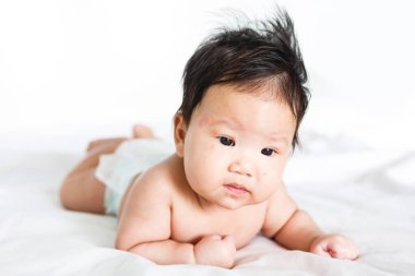 Asian baby girl with red spots on skin face clipart