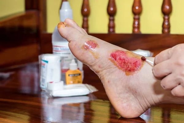 Fresh blood blisters on women\'s feet,reflection and side effect from motorcycle accident lesion injurie