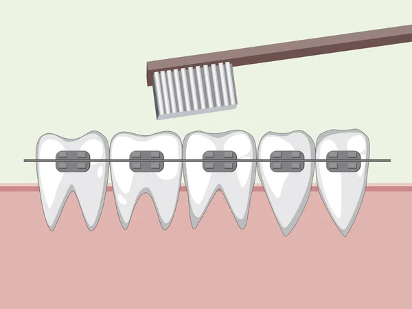 Vektorzähne mit Zahnspange und Zahnbürste — Stockvektor