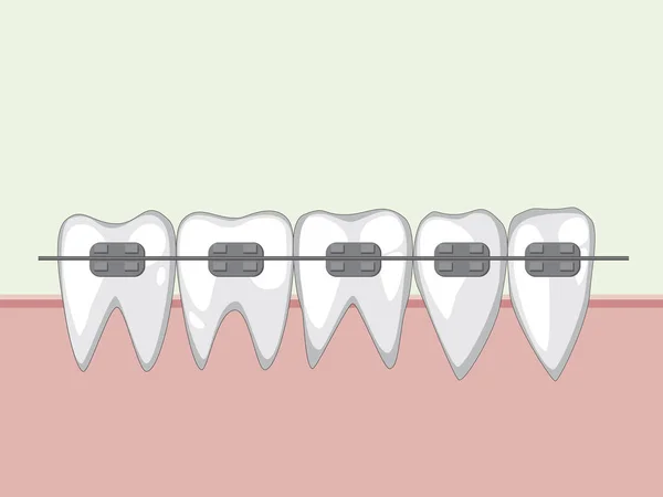 Vector white teeth in the gum with metal braces — Stock Vector