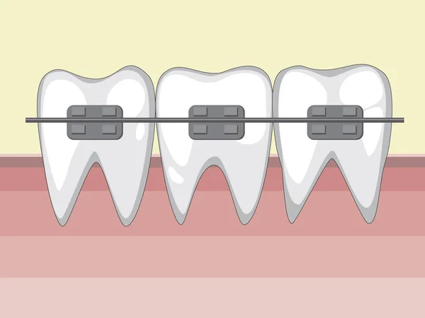 Dientes blancos vectoriales con tirantes metálicos después del dentista — Vector de stock