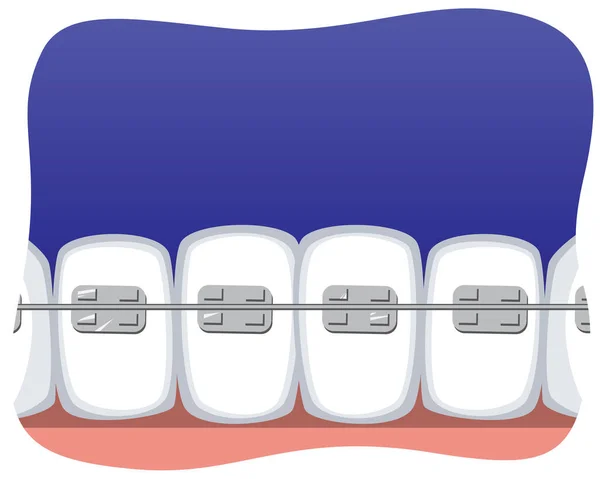 テキストのためのブレースとスペースを持つ歯や青の背景にスペースをコピーします 矯正サービス ブレース 一口アライメントの概念として臼歯と切開部を持つフラットベクトルストックイラスト — ストックベクタ