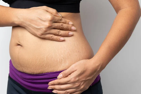 Γυναίκες Επιδεικνύουν Την Κοιλιά Μετά Γέννηση Stretch Marks Λευκό Φόντο — Φωτογραφία Αρχείου