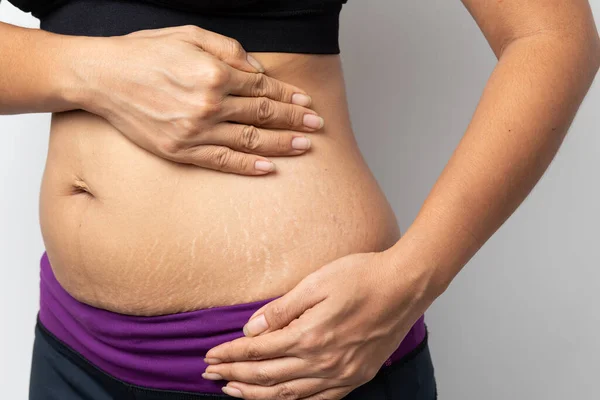 Femeile Îşi Arată Burta După Naştere Stretch Marks Fundal Alb — Fotografie, imagine de stoc