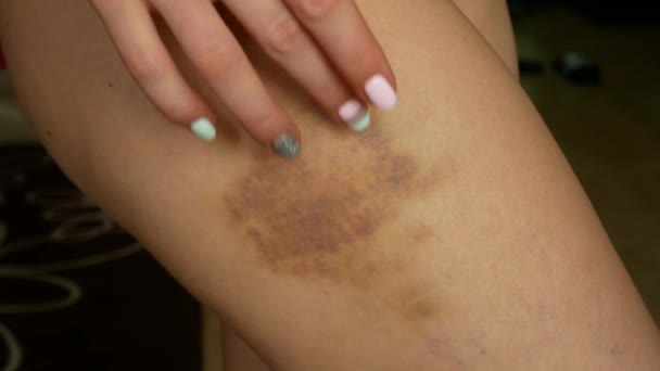 Female hand smears bruise ointment on her hip — Stock Video