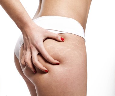 İşaretleri kadının kalça germek. Cilt bakım kavramı.