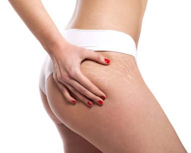 Stretch marks on woman's buttocks. Skin care concept. clipart