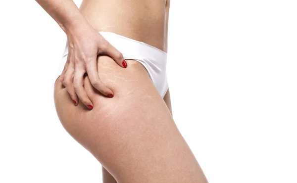 Stretch marks on woman\'s buttocks. Skin care concept.