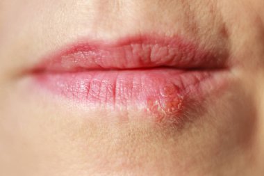 Close-up of woman's lips with cold sores on the lower lip clipart