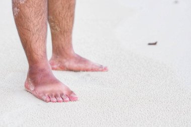 Yaz güneşi ayaklarını kavurabilir - güneş yanığı
