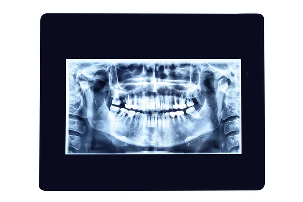 Рентгеновская Фотография Зубов Изолированный Белом Фоне — стоковое фото