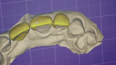 Bilgisayar diş implantı ekipmanlarında 3 boyutlu modelleme dişleri tıbbi stomatoloji teknolojisi tanısı tarama dişleri yavaş çekim
